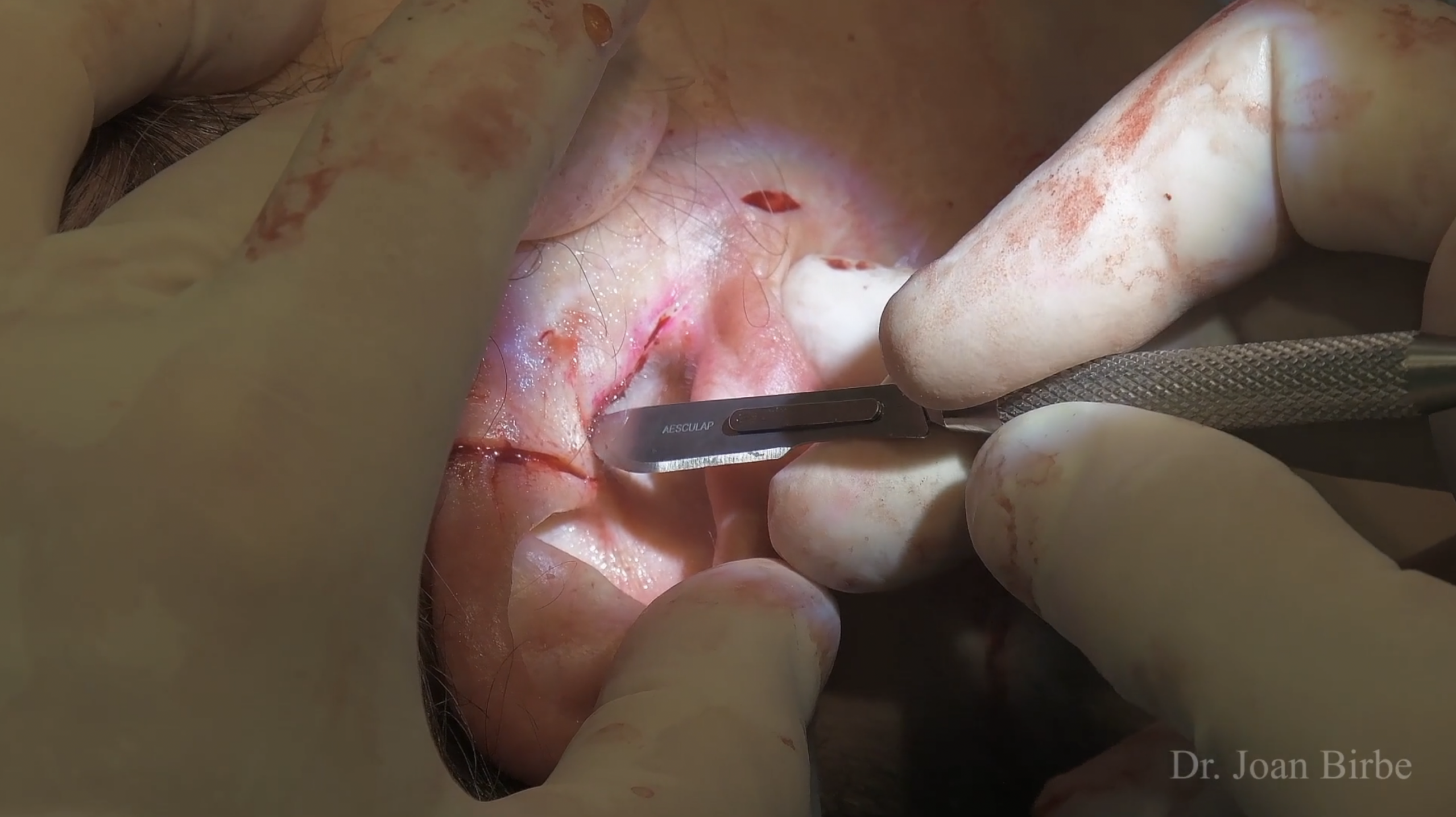 Brow lift – Dr Joan Birbe