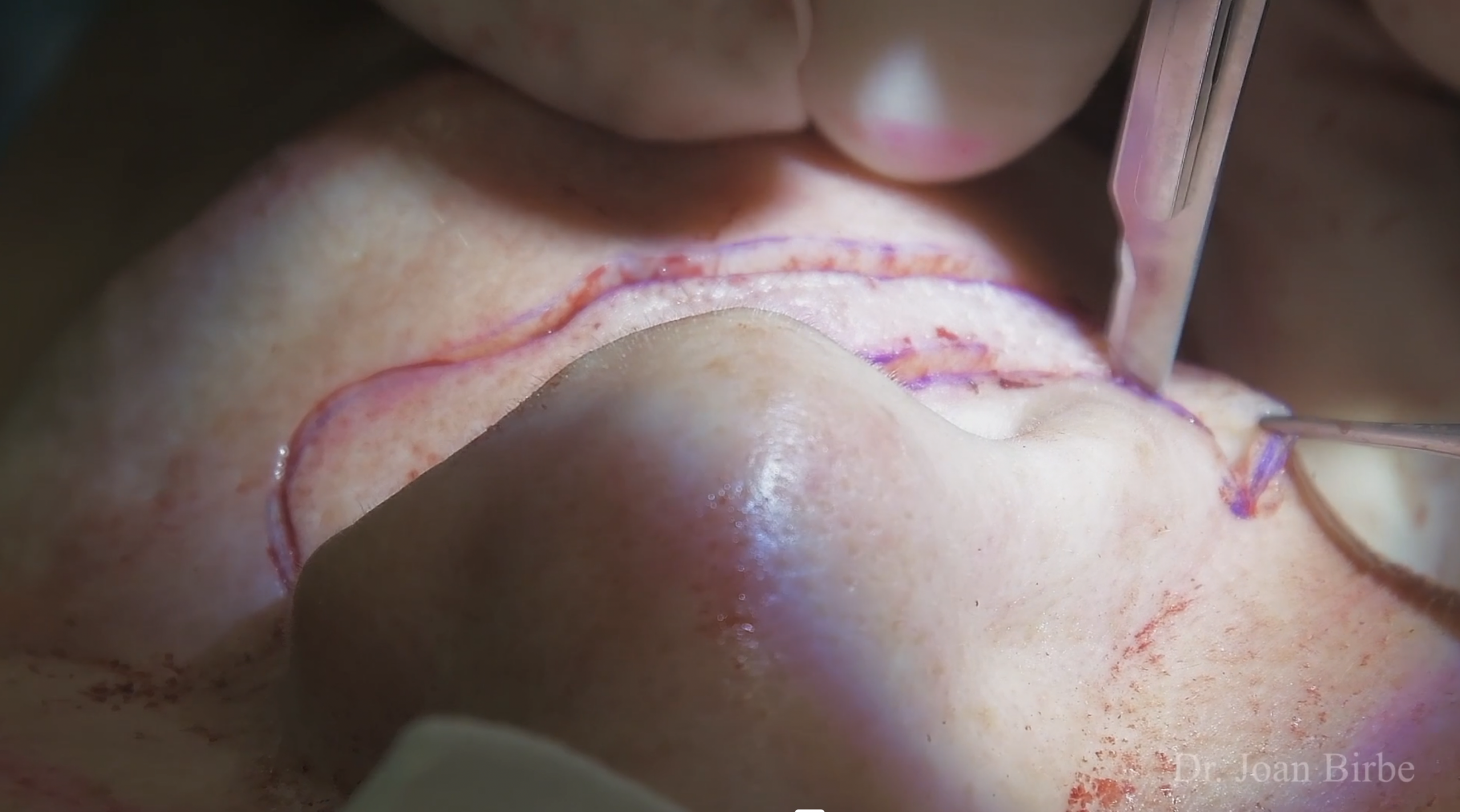 Lip lift – Dr Joan Birbe