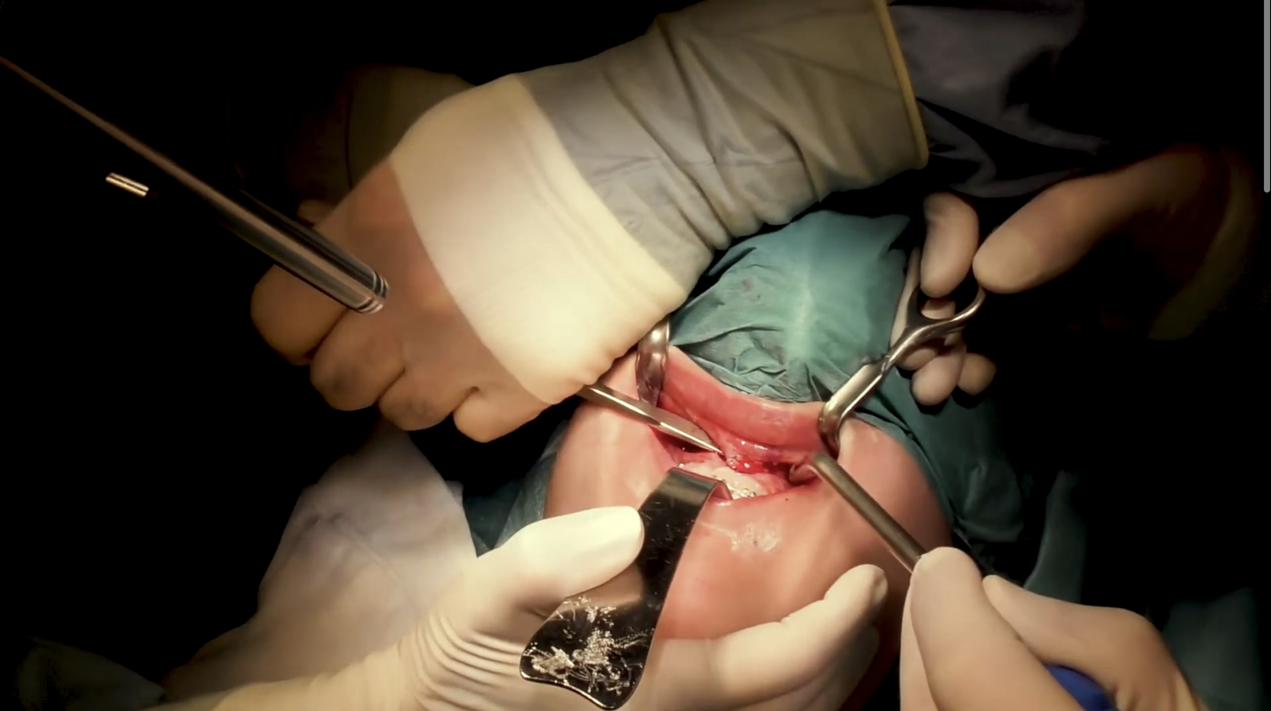 Le fort I type osteotomy