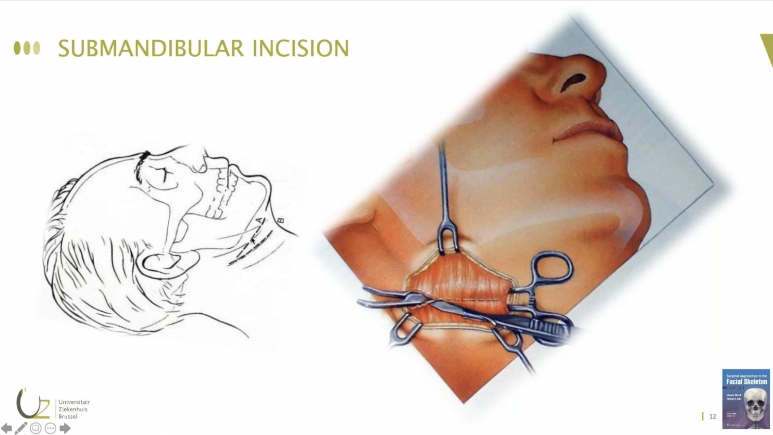 A Crash Course on total alloplastic TMJ replacement