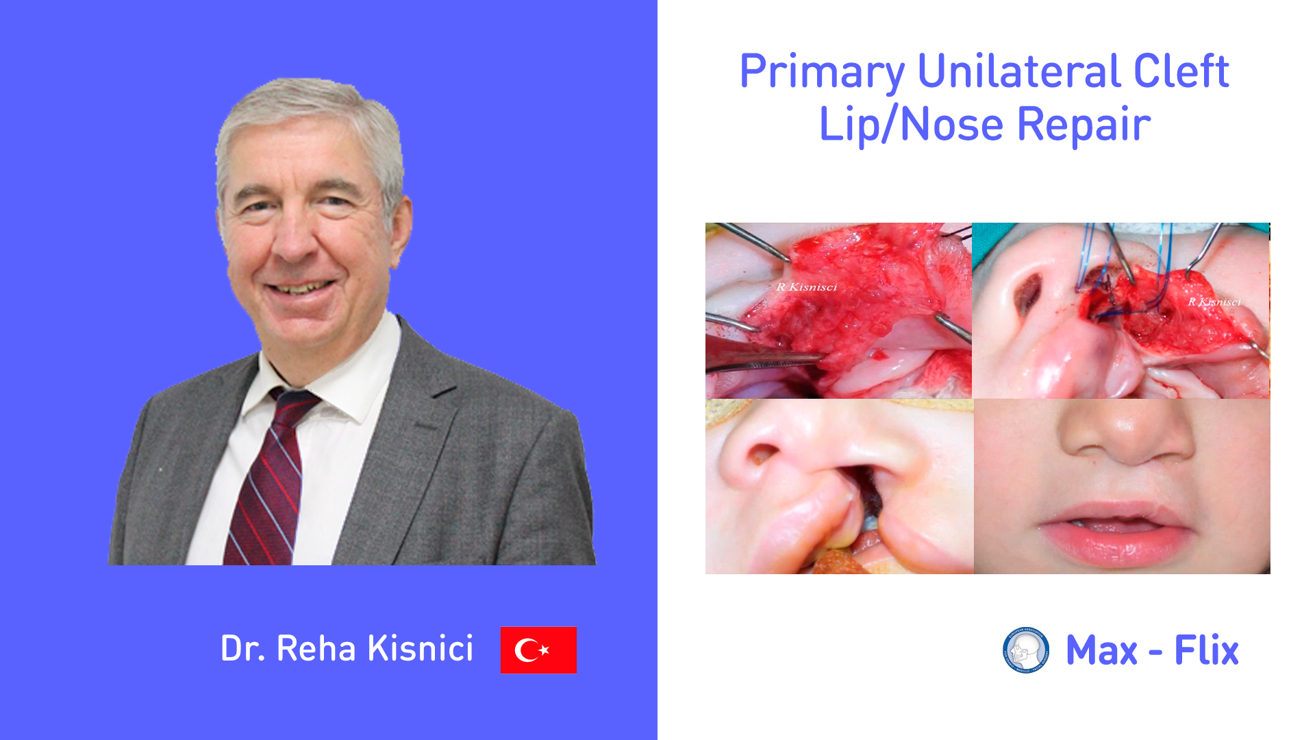 Primary Unilateral Cleft Lip/Nose Repair
